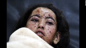 The civil war in Yemen continues to rage for more than a year and a half. This young girl awaits a doctor after being wounded in an airstrike.